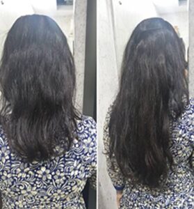 Prosthetic Hair for Women Before After