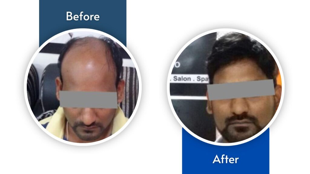 Hair Fixing | Non Surgical Hair Replacement in Hyderabad - Celebrity Secrets