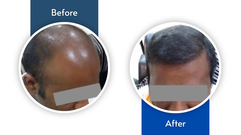 Hair Fixing | Non Surgical Hair Replacement in Hyderabad - Celebrity Secrets
