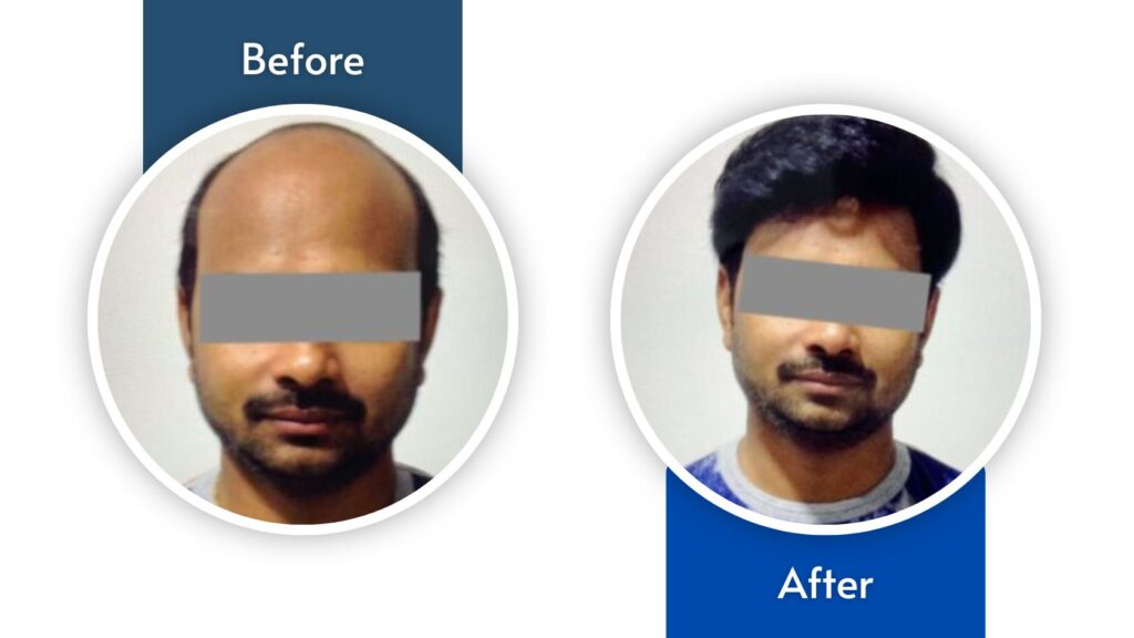 Hair Fixing Treatment  Best Hair Replacement in Hyderabad Vijayawada   Kakinada