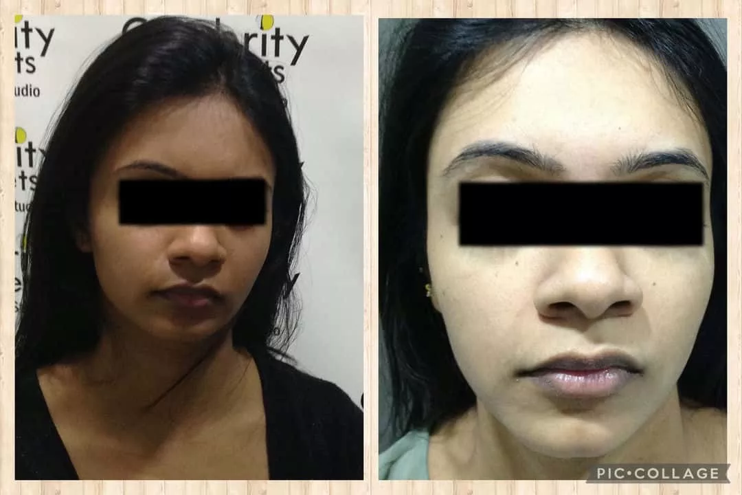 Glutathione Skin Whitening & Hair Treatment Before & After Results