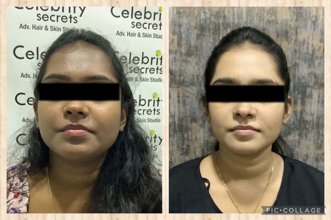 glutathione before and after celebrity