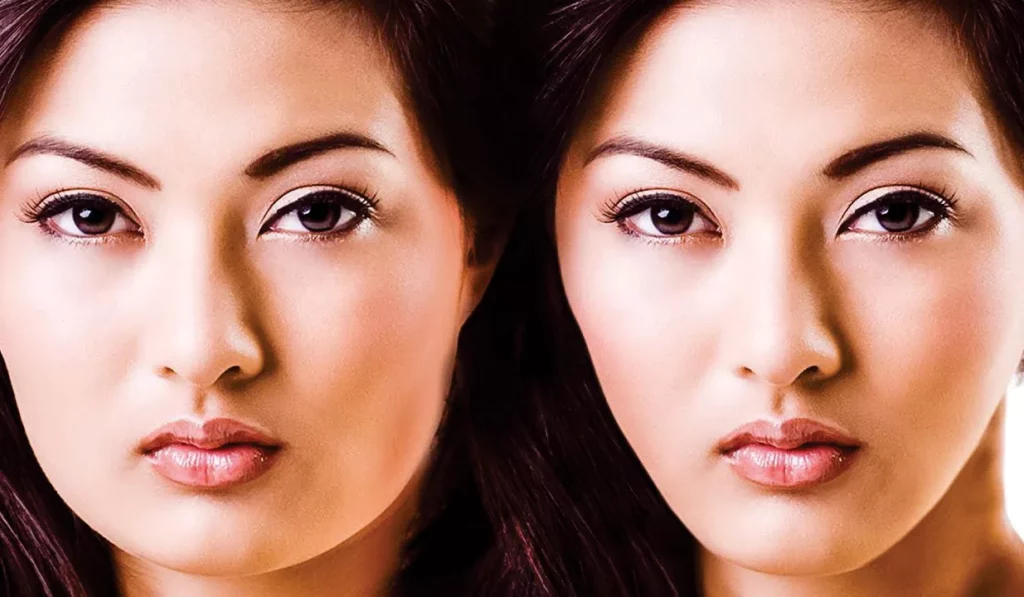 Brief About V-Shape Face Lift Treatment, Jubilee Hills, Hyderabad -  Celebrity Secrets