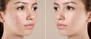 acne scars treatment in vijayawada