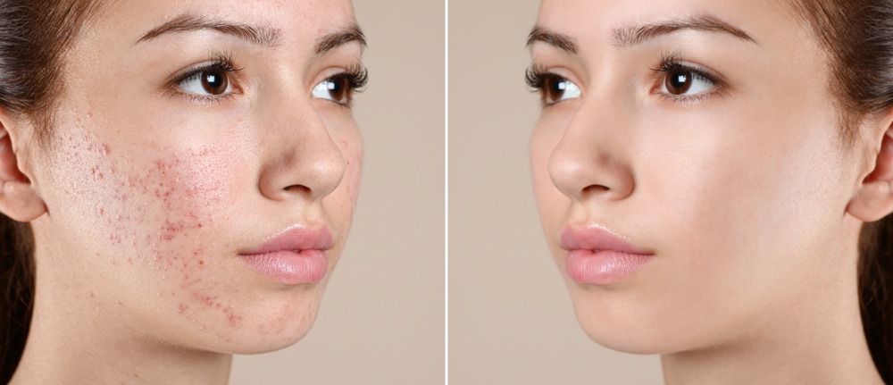 acne scars treatment in vijayawada
