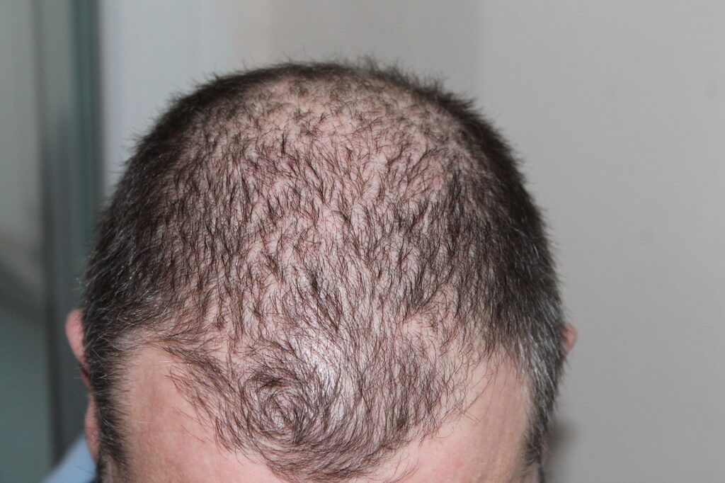 hair, man, hair loss-248050.jpg