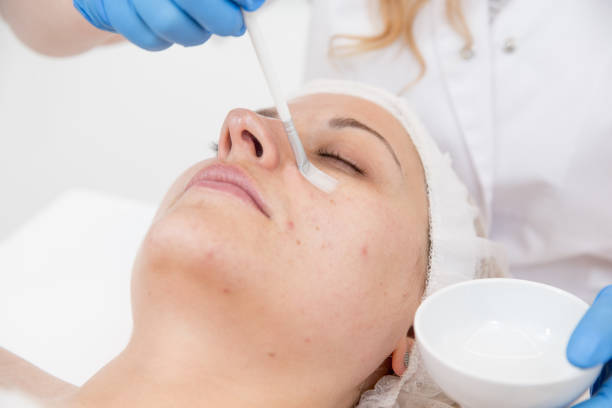 Customized chemical whitening peels